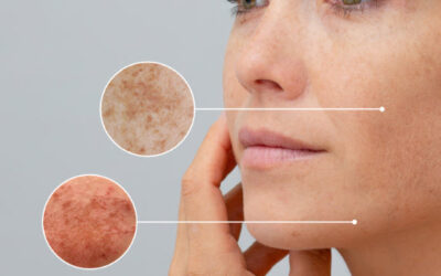 Fotoprotección oral: la evidencia frente al daño solar